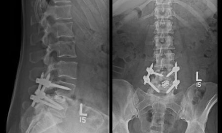 Spinal Fusion Devices Market Growth