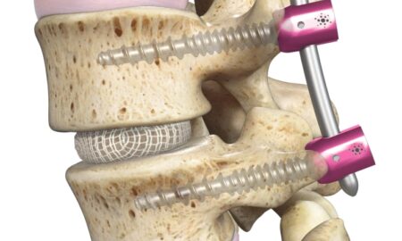 spinal fusion devices market