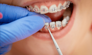 How Braces Work