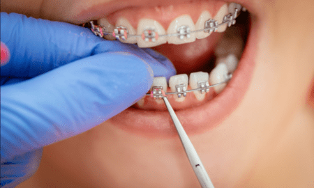 How Braces Work