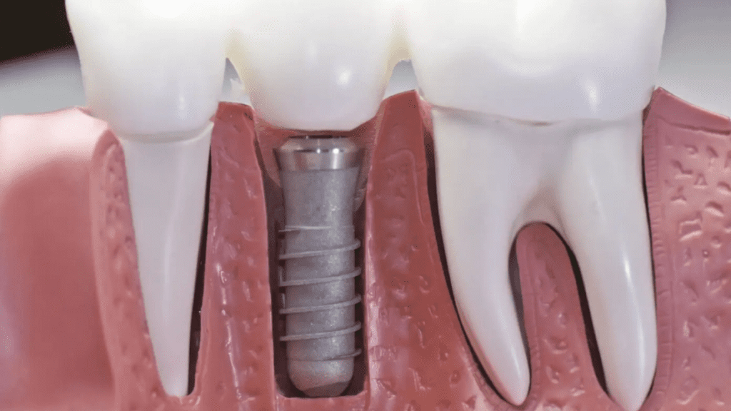 Dental Implants