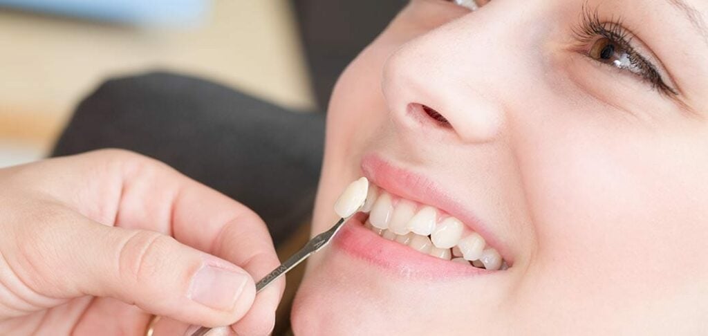 Porcelain Veneers Cost