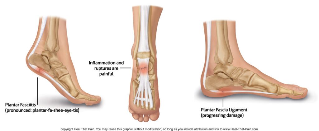 Plantar Fascia Rupture: Causes, Symptoms, and Effective Treatment Options
