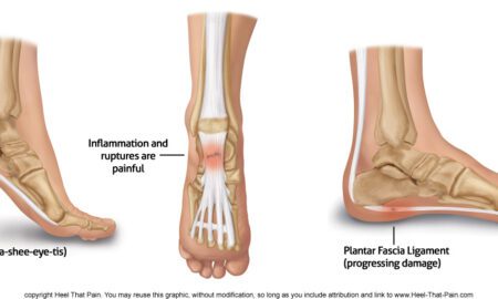 Plantar Fascia Rupture: Causes, Symptoms, and Effective Treatment Options