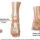 Plantar Fascia Rupture: Causes, Symptoms, and Effective Treatment Options