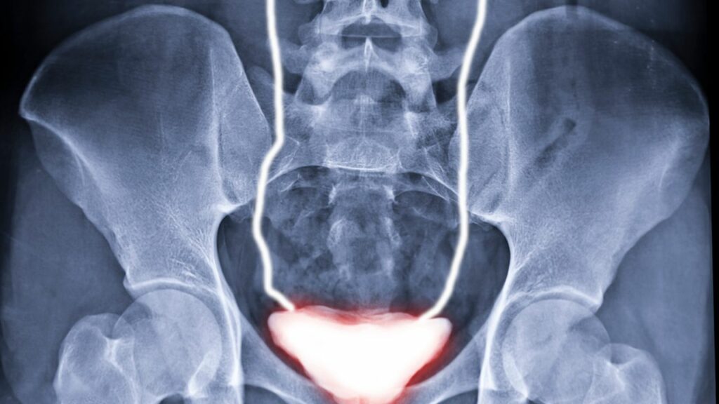 dr raul fernandez crespo discusses the role of genetics in the urinary tract system