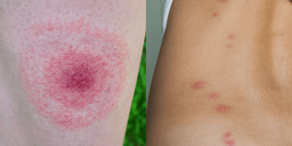 Insect Bites