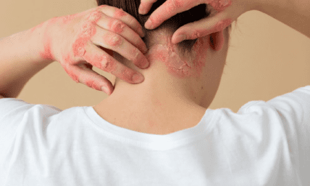 Seborrheic Dermatitis