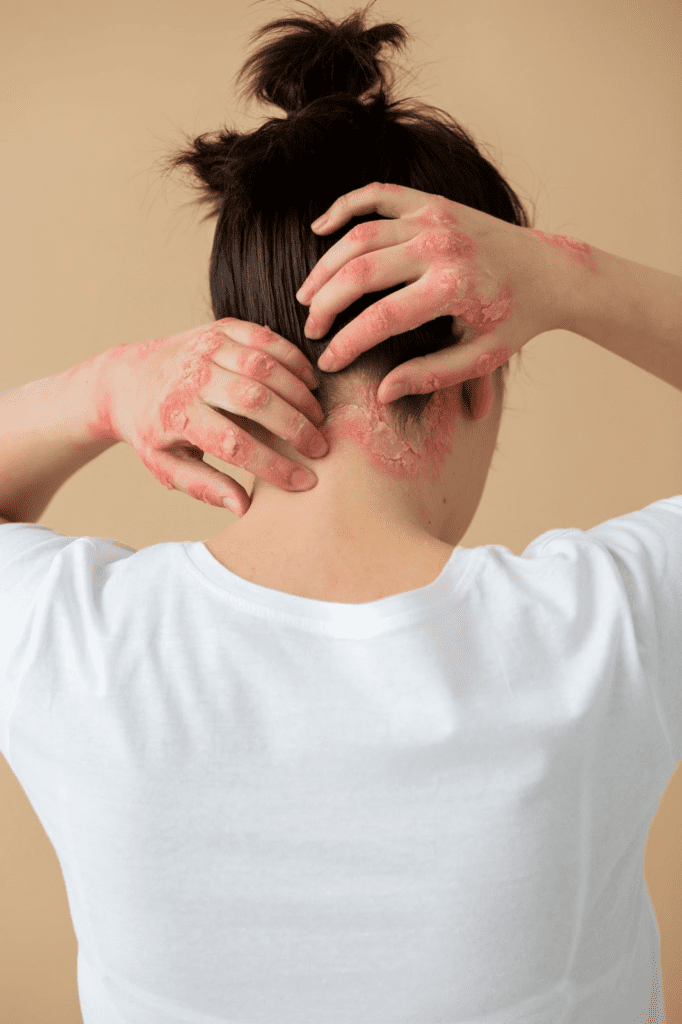 Seborrheic Dermatitis