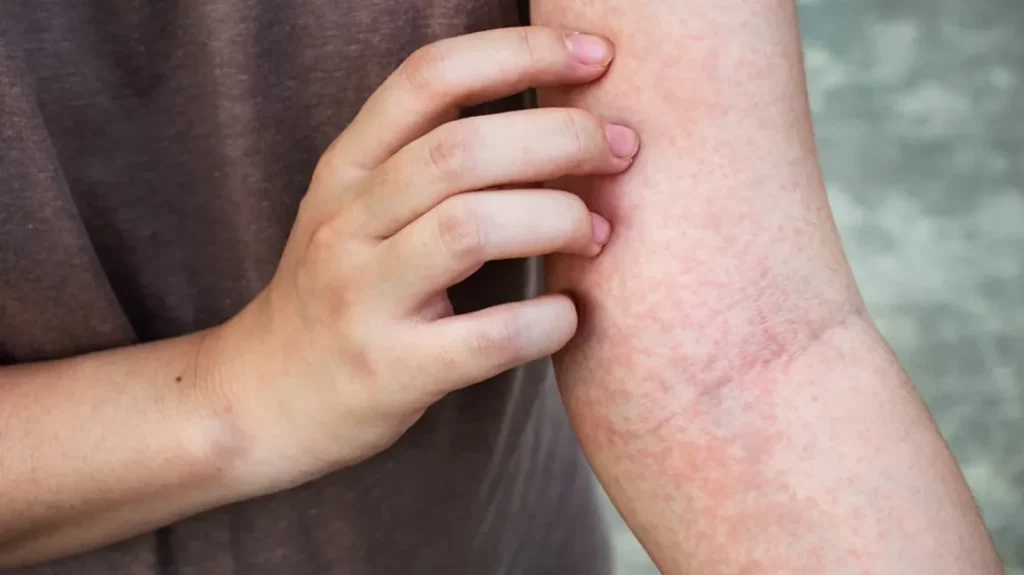 What Causes Itching That Moves Around The Body