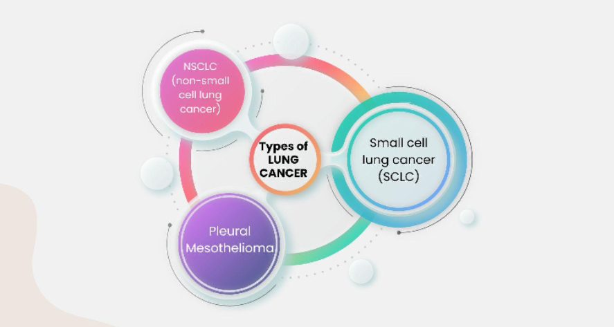 Lung Cancer: Causes, Types, Stages &amp; Treatment