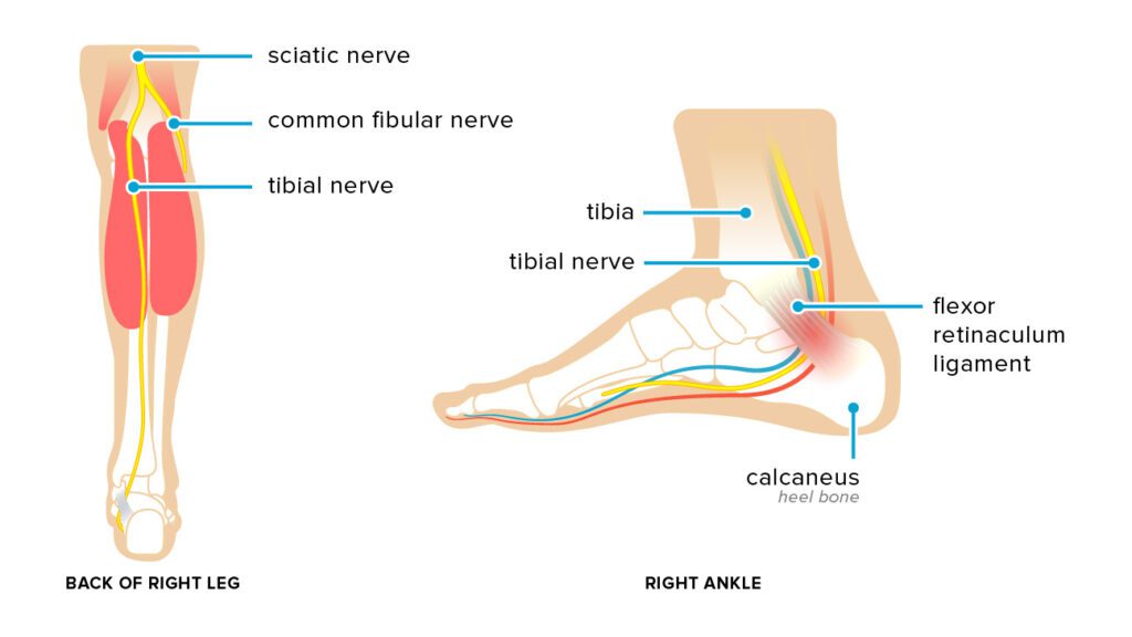Sciatica: What It Is, Causes, Symptoms, Treatment & Pain