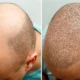 Hair Transplantation in Turkey