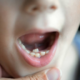 Shark Teeth In Children