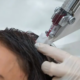 Hair Loss Treatment in Sydney