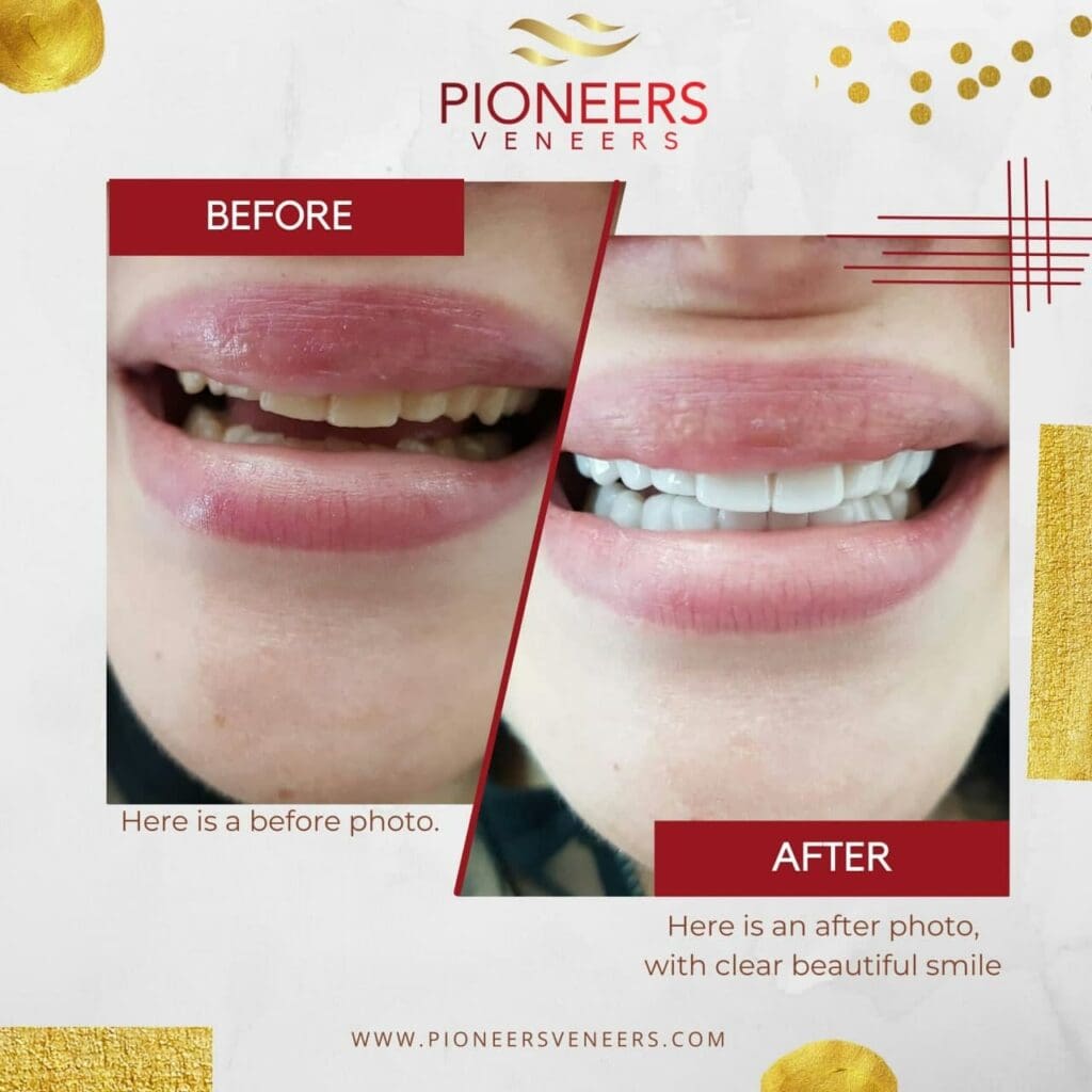 Snap-On Veneers