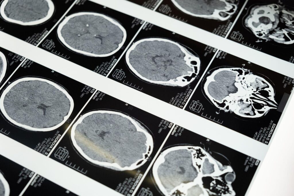 When every second counts in a brain injury case, seeking the assistance of a brain injury lawyer is essential.