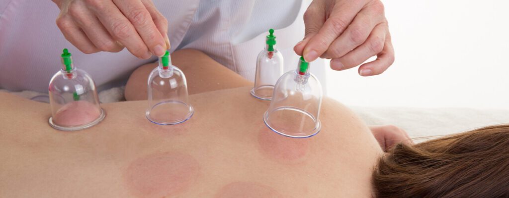 Unfolding the Mysteries: What to Expect During Your First Cupping Therapy Session