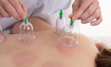 Unfolding the Mysteries: What to Expect During Your First Cupping Therapy Session