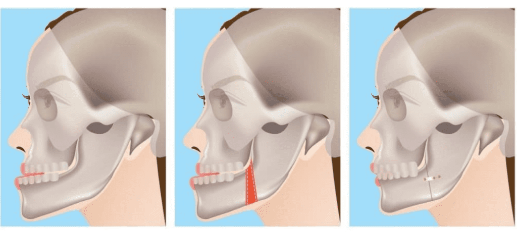 Jaw Surgery