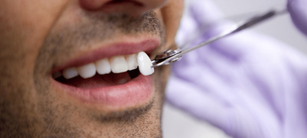 Porcelain Veneers