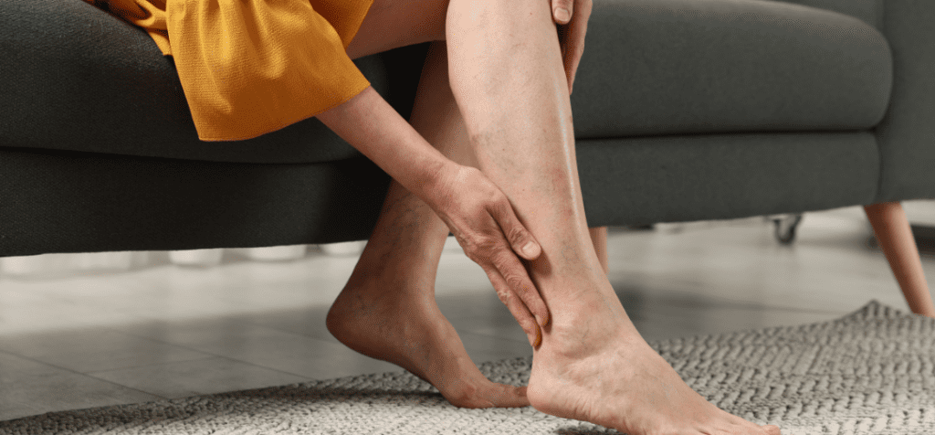 Varicose Vein