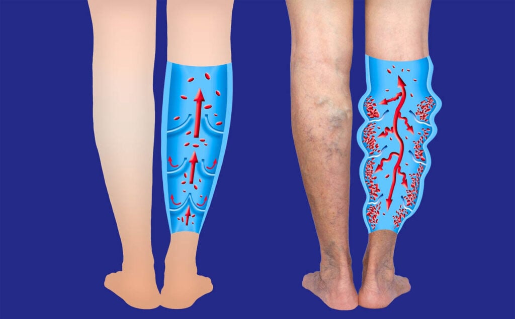 Varicose Vein Treatment