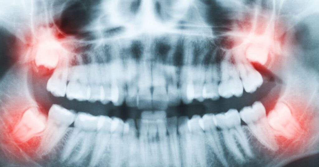 Wisdom Teeth Removal