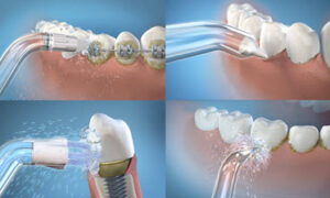 Water Flosser