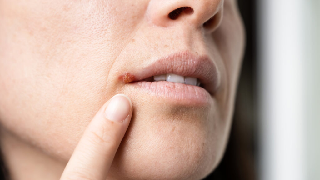 Aciclovir Explained