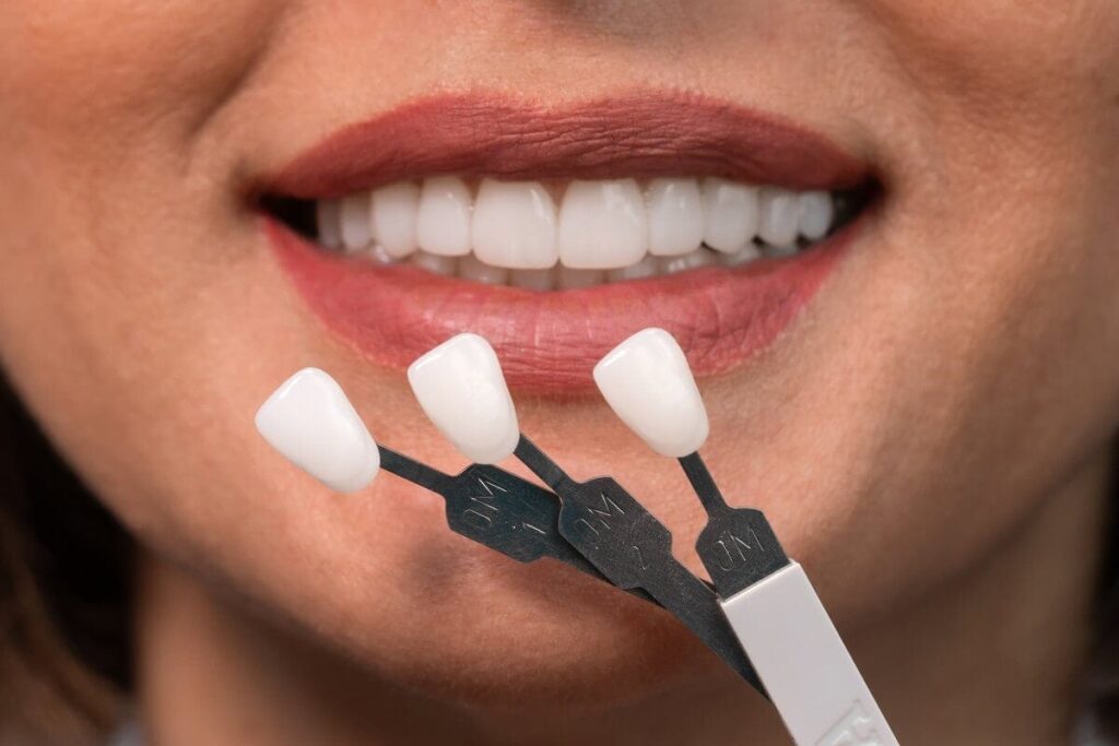 Dental Veneers