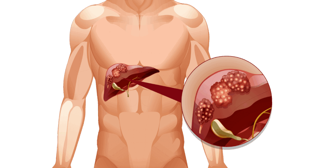 Liver Cancer