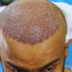 Hair Regrowth
