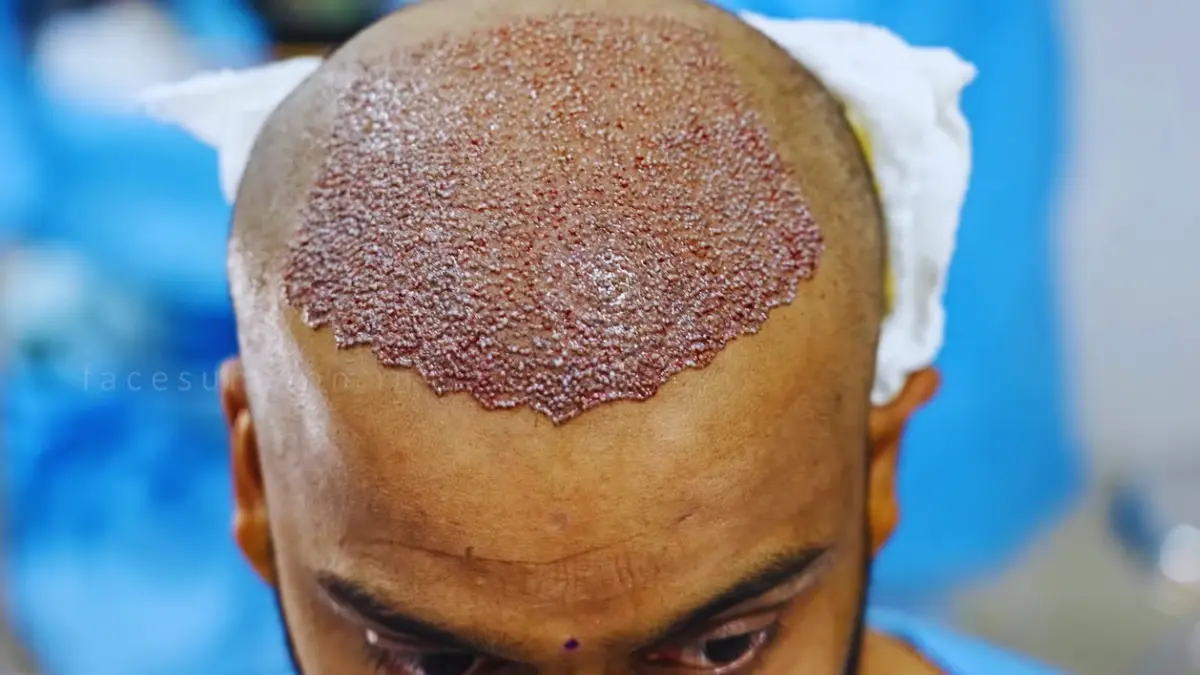 Hair Regrowth