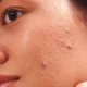Acne Scar Treatment