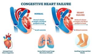 Understanding Heart Failure