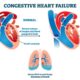 Understanding Heart Failure