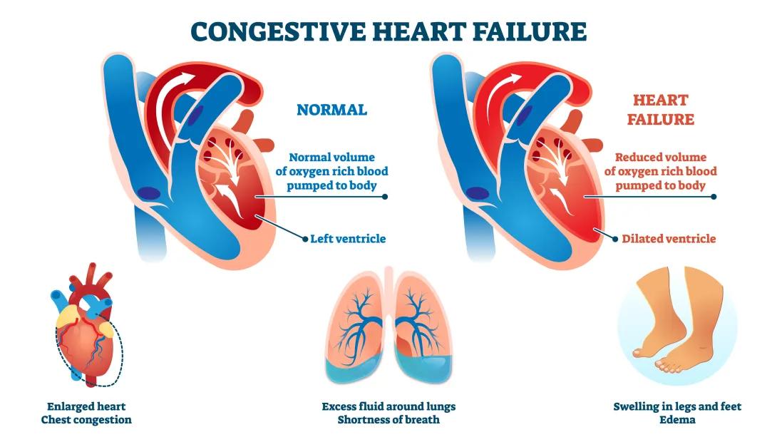 Understanding Heart Failure