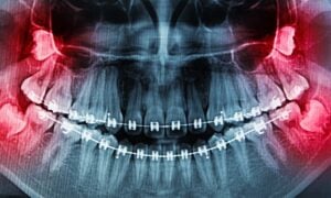 Wisdom Tooth Extraction Cost