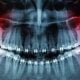 Wisdom Tooth Extraction Cost