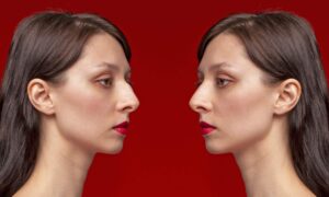 Redefining Beauty: The Impact of Rhinoplasty