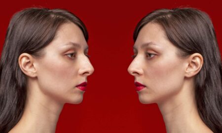 Redefining Beauty: The Impact of Rhinoplasty