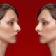 Redefining Beauty: The Impact of Rhinoplasty