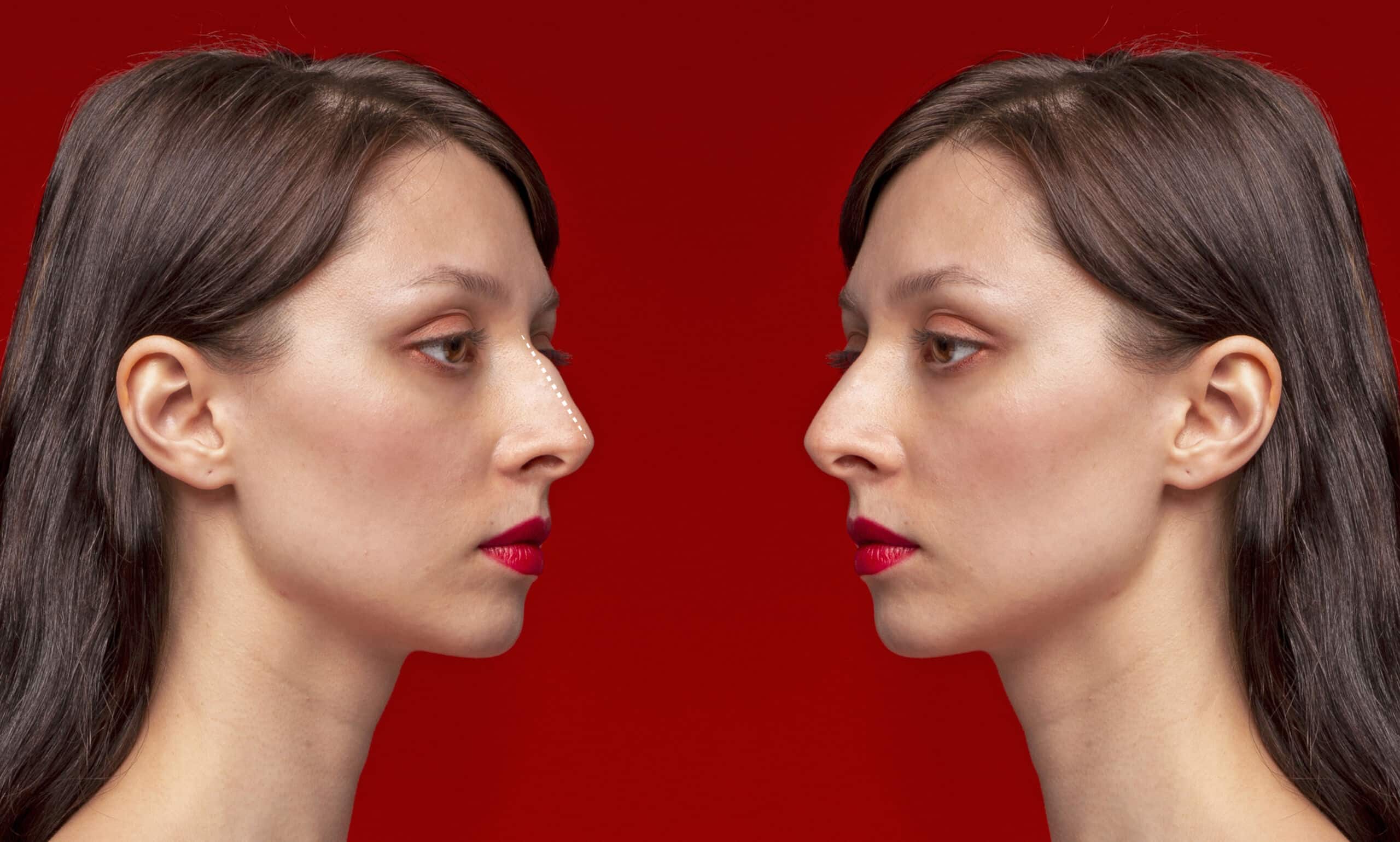 Redefining Beauty: The Impact of Rhinoplasty