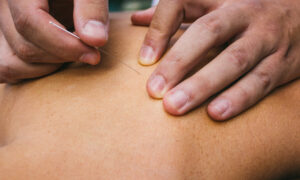 IMS Dry Needling vs. Acupuncture