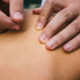 IMS Dry Needling vs. Acupuncture