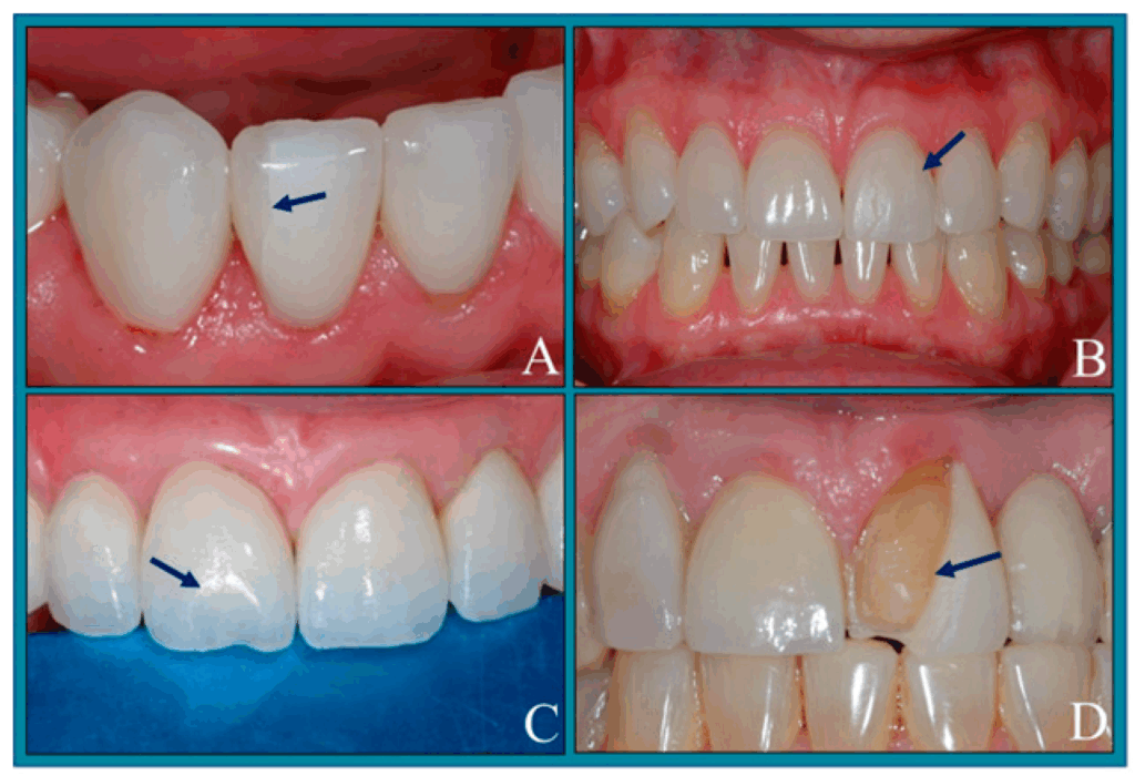 Cosmetic Dentist Compares The Top 3 Veneer Materials
