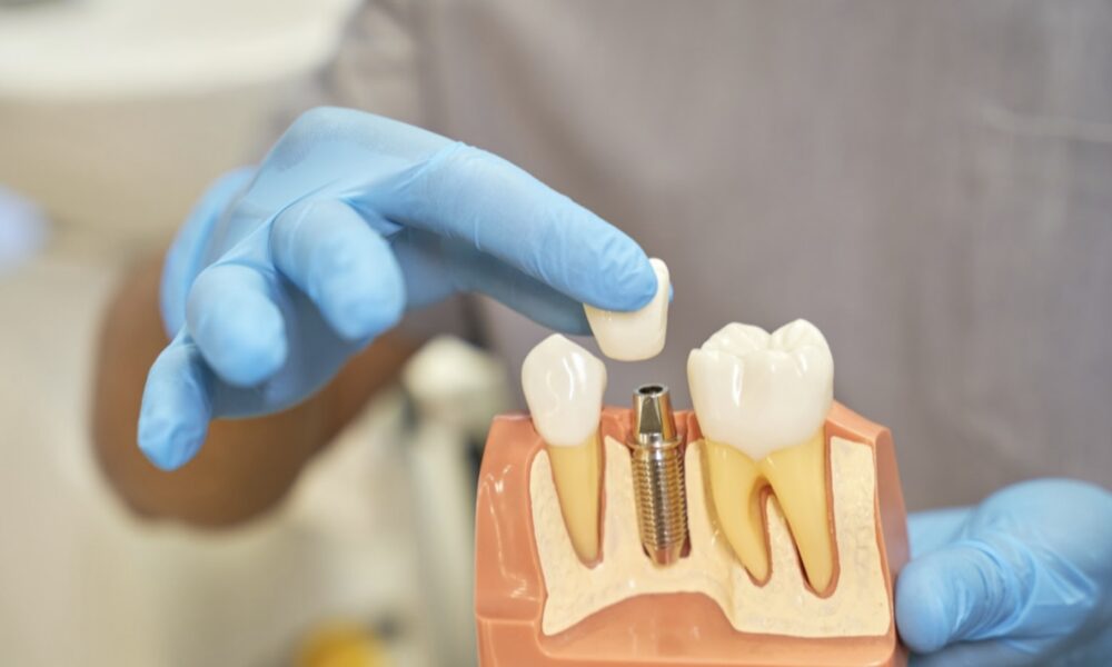 Who Is a Good Candidate for Dental Implants?