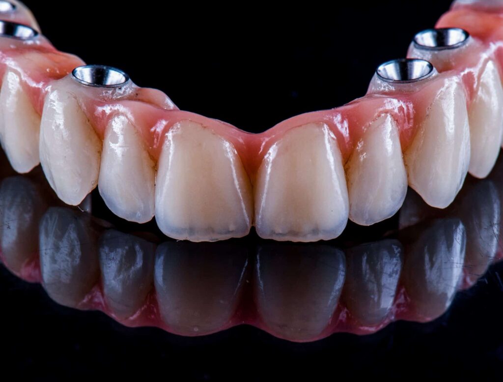 Dental Implants
