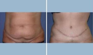 NYC Women Are Turning to Tummy Tucks